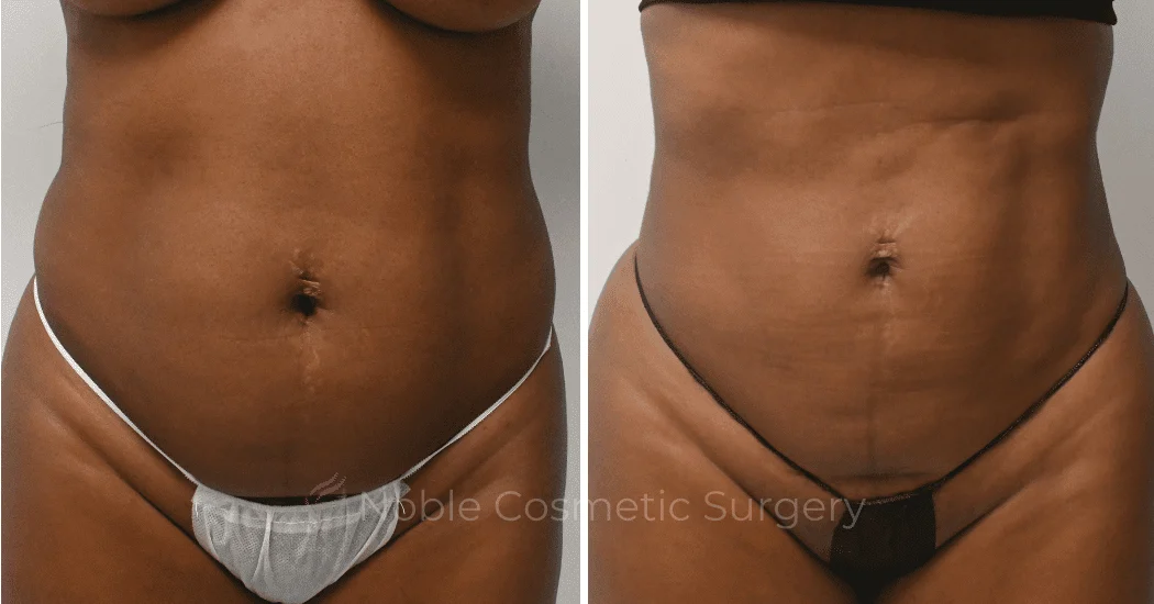 LIPOSUCTION-CASE-10510 | Before and After Liposuction 1