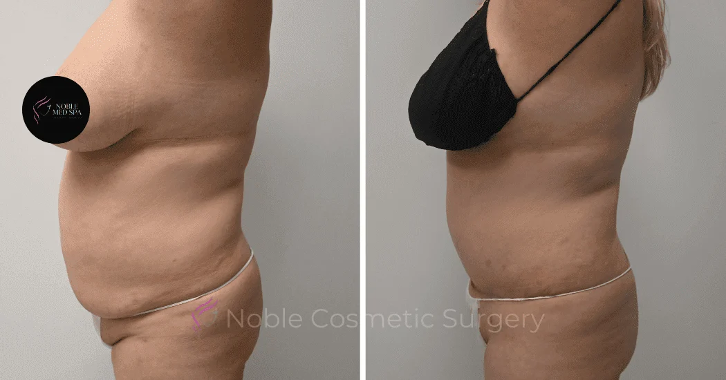 TUMMY-TUCK-CASE-10538 | Before and After Abdominoplasty 5