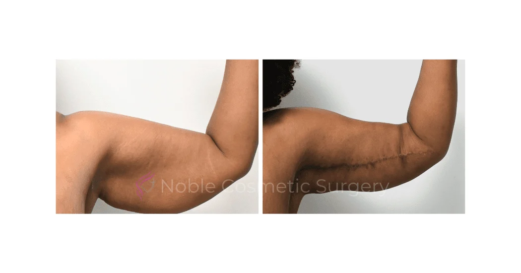 ARM-LIFT-CASE-10784 | Before and After Brachioplasty 1