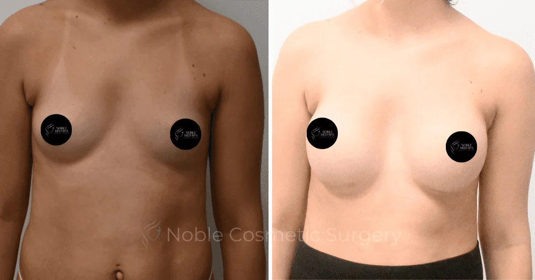 BREAST-AUGMENTATION-CASE-11094 | Before and After Breast Augmentation 1