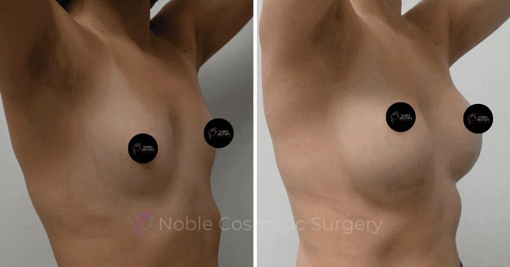 BREAST-AUGMENTATION-CASE-11094 | Before and After Breast Augmentation 2