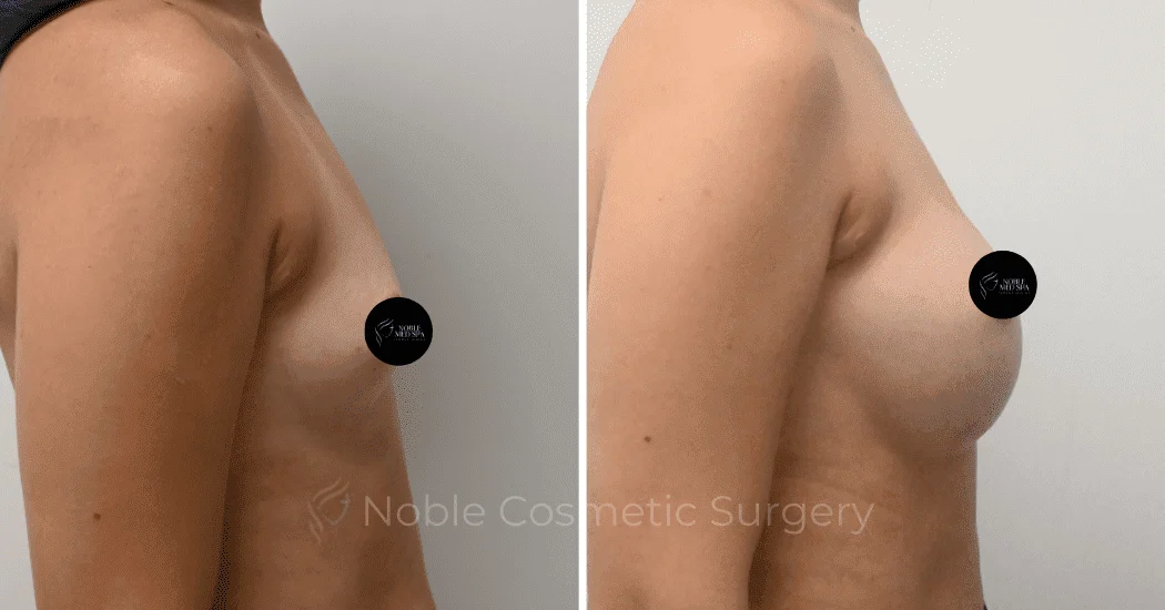 BREAST-AUGMENTATION-CASE-11094 | Before and After Breast Augmentation 3