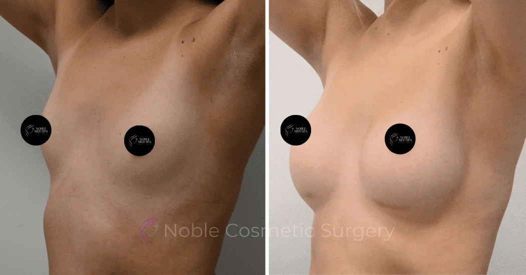 BREAST-AUGMENTATION-CASE-11094 | Before and After Breast Augmentation 4