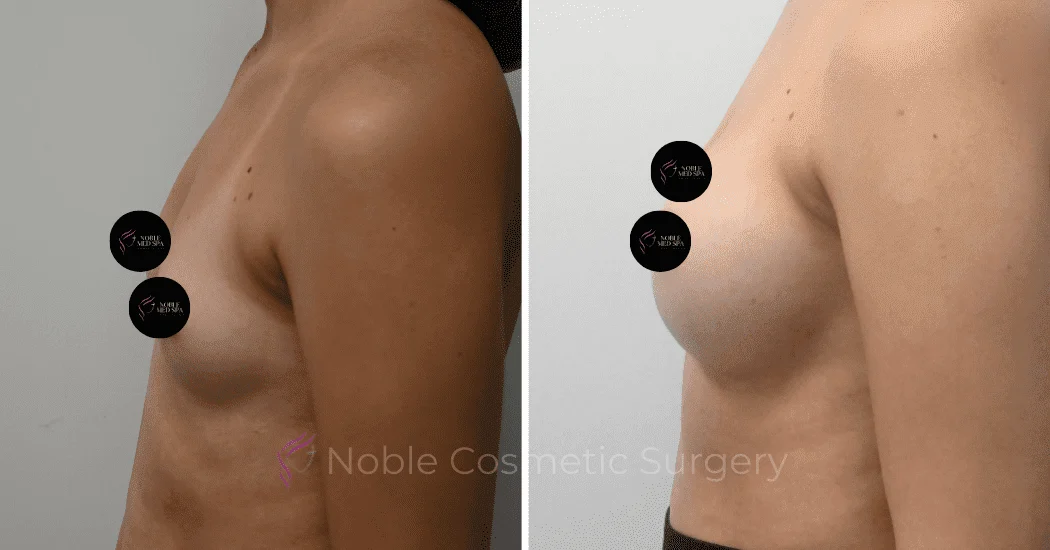 BREAST-AUGMENTATION-CASE-11094 | Before and After Breast Augmentation 5