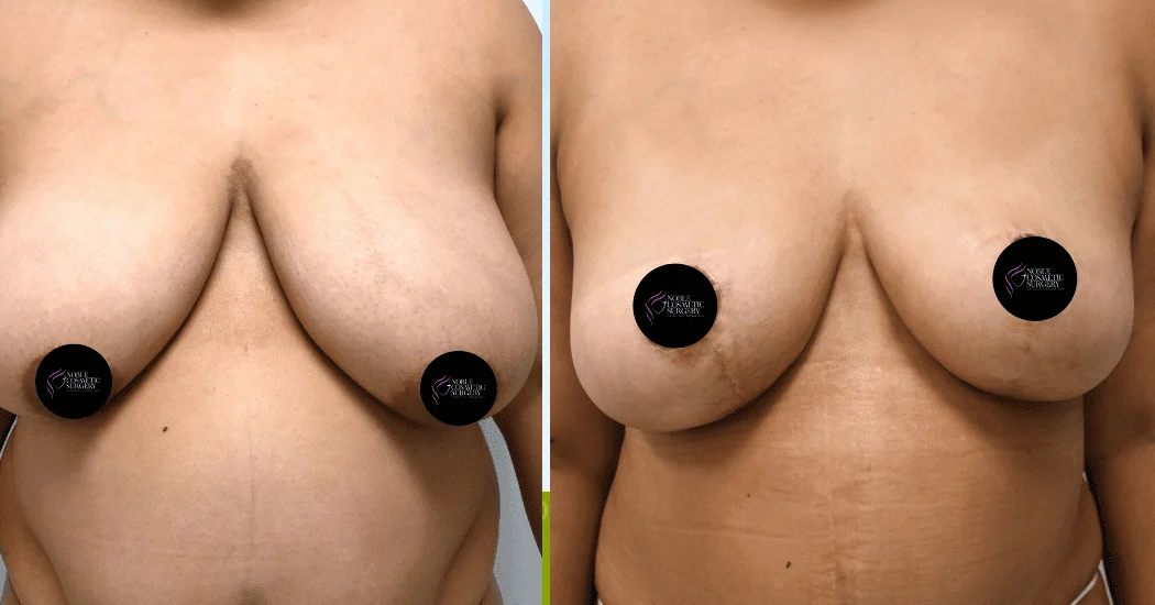 BREAST-REDUCTION-CASE-11303 | Before and After Breast Reduction 1