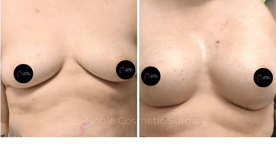 BREAST-AUGMENTATION-CASE-11771 | Before and After Breast Augmentation 1