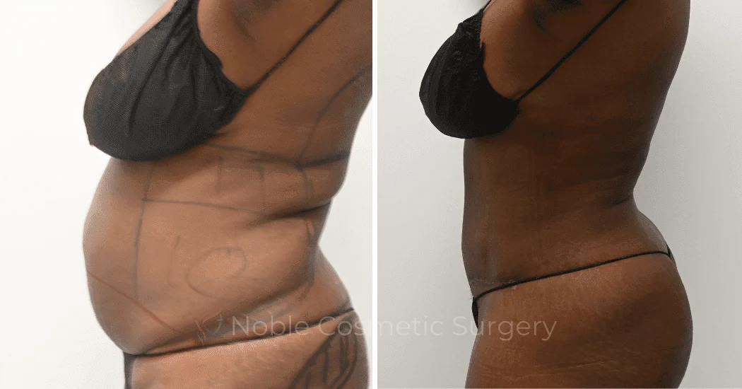 TUMMY-TUCK-CASE-11298 | Before and After Abdominoplasty 5