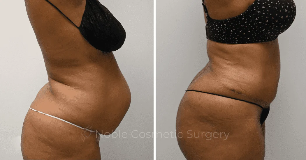 TUMMY-TUCK-CASE-11974 | Before and After Abdominoplasty 2