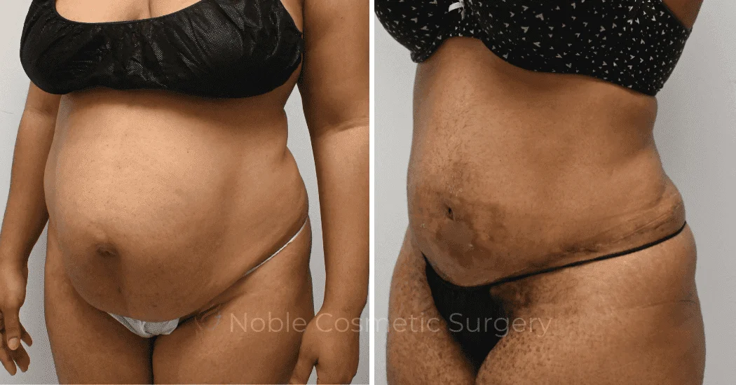 TUMMY-TUCK-CASE-11974 | Before and After Abdominoplasty 3