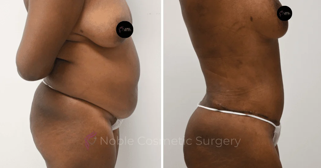TUMMY-TUCK-CASE-12002 | Before and After Abdominoplasty 2