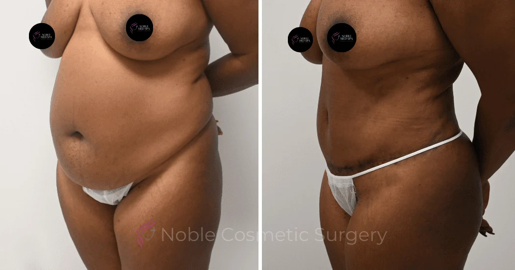 TUMMY-TUCK-CASE-12002 | Before and After Abdominoplasty 3