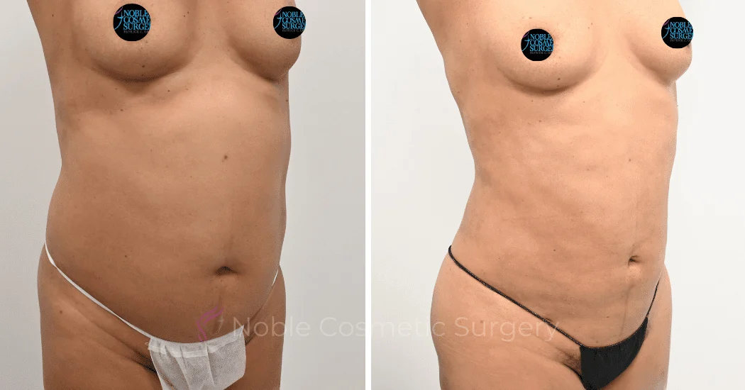 LIPOSUCTION-ABDOMEN-CASE-12162 | Before and After Liposuction 1