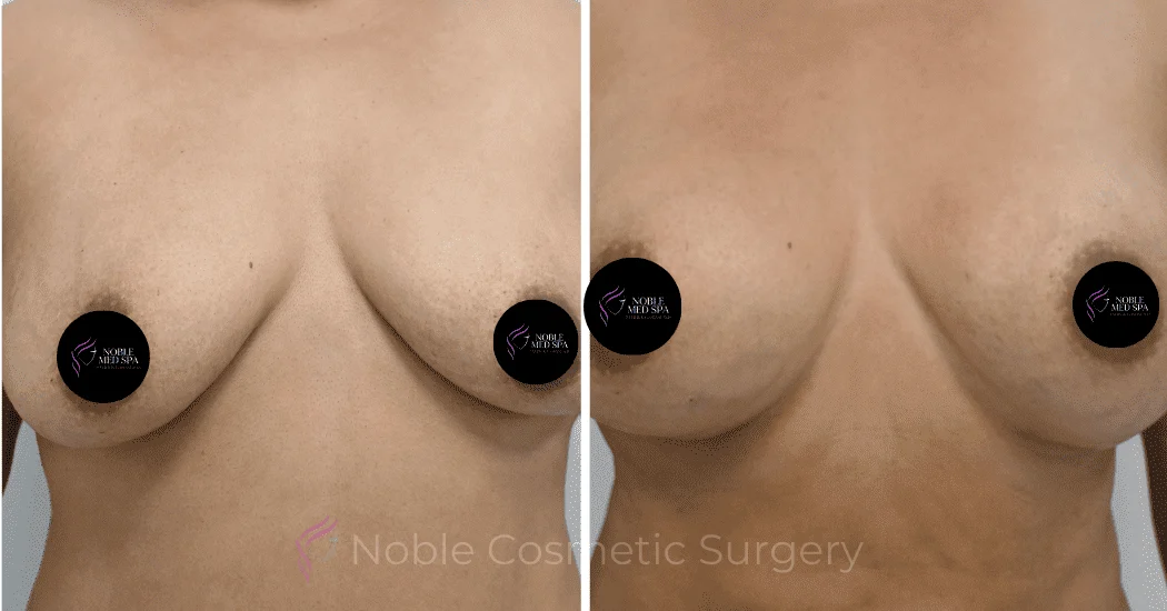 BREAST-AUGMENTATION-CASE-12466 | Before and After Breast Augmentation 1