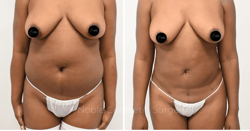LIPOSUCTION-CASE-12998 | Before and After Liposuction 1