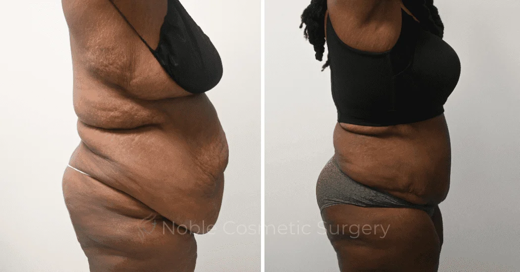 TUMMY-TUCK-CASE-14955 | Before and After Abdominoplasty 5
