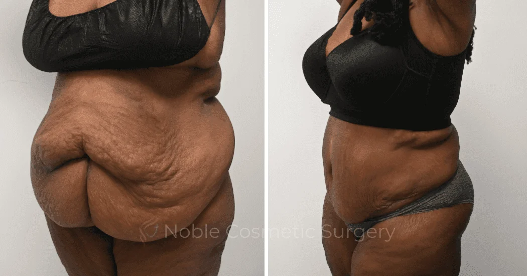 TUMMY-TUCK-CASE-14955 | Before and After Abdominoplasty 3