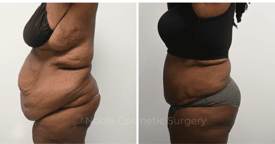 TUMMY-TUCK-CASE-14955 | Before and After Abdominoplasty 4