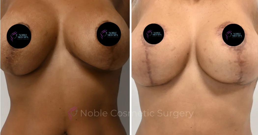 BREAST-AUGMENTATION--WITH-LIFT--CASE-16458 | Before and After Breast Augmentation with Lift 1