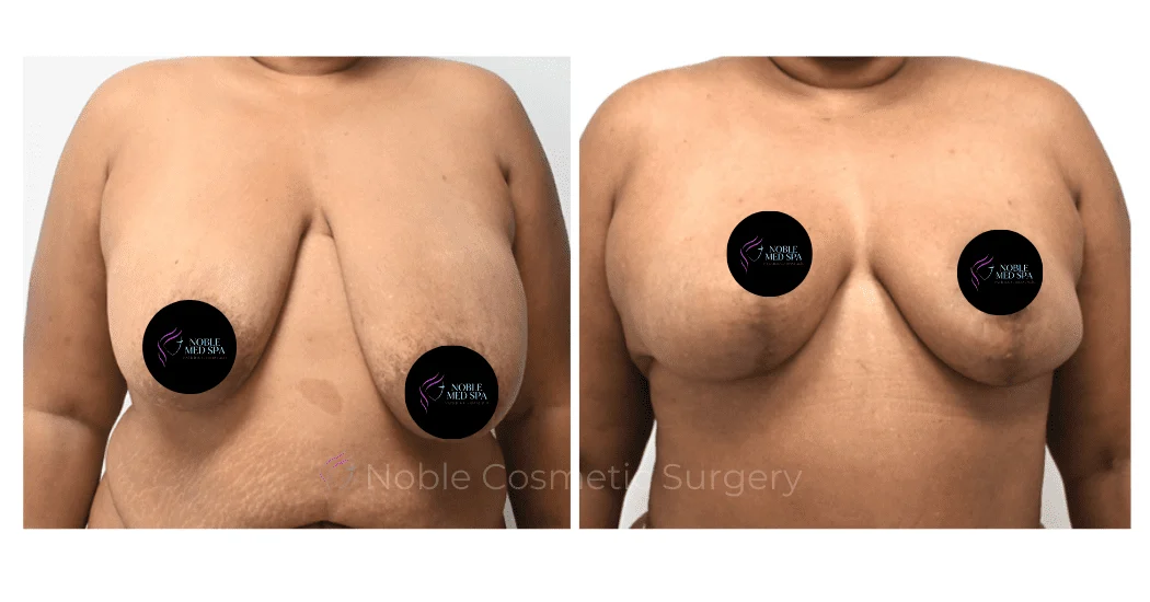 BREAST-REDUCTION-CASE-19222 | Before and After Breast Reduction 1