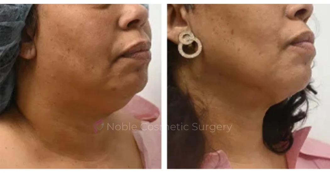 SUBMENTAL-LIPOSUCTION--CHIN--CASE-19224 | Before and After Chin Liposuction 1