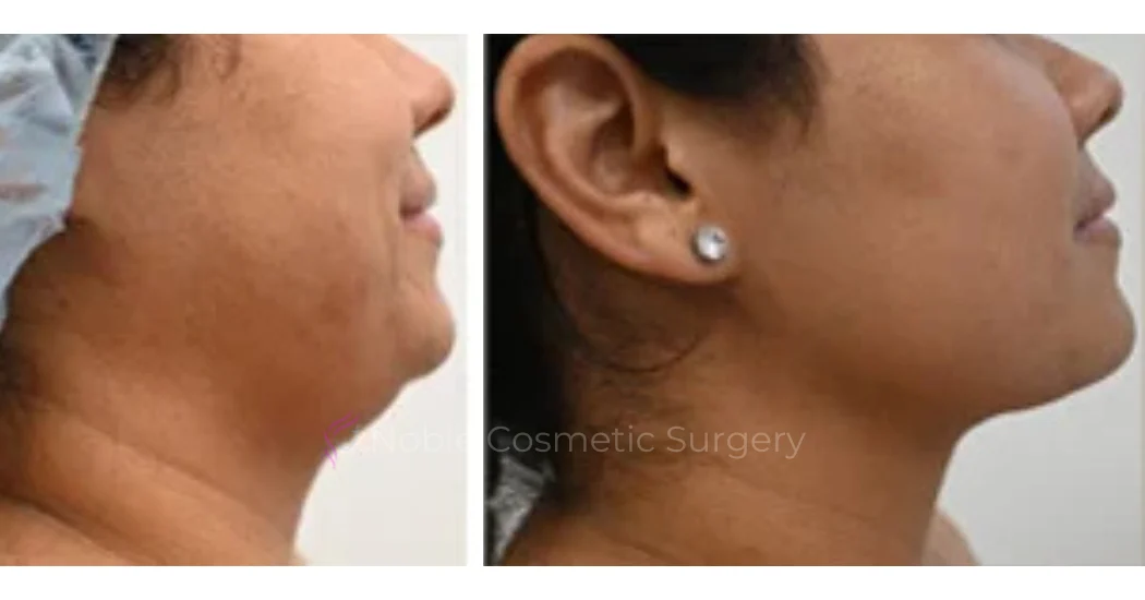 SUBMENTAL-LIPOSUCTION--CHIN--CASE-19225 | Before and After Chin Liposuction 1