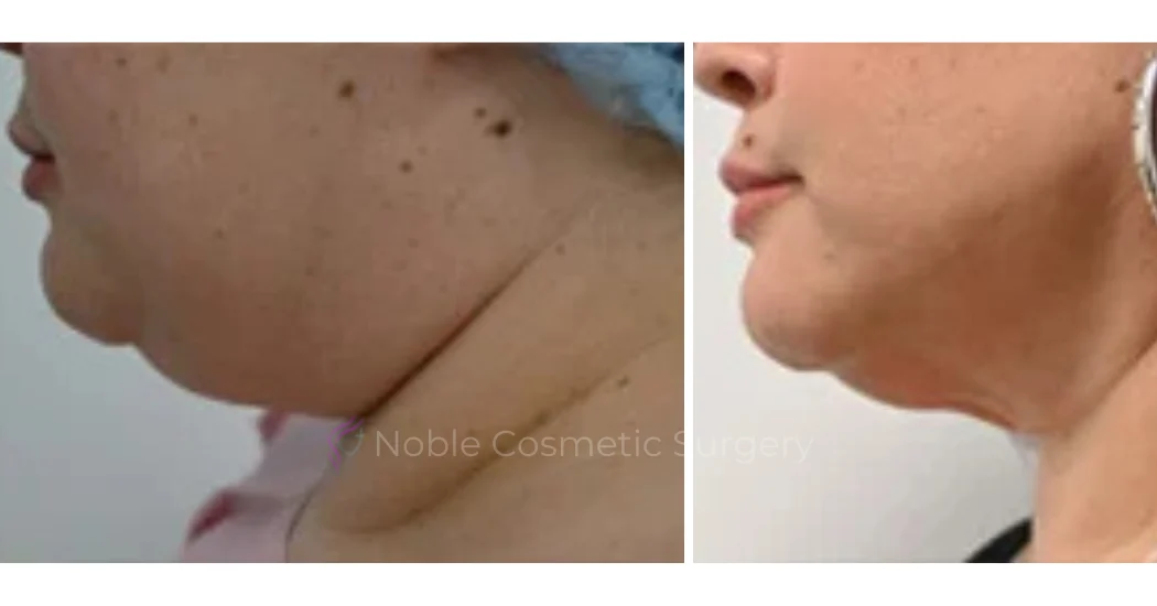 SUBMENTAL-LIPOSUCTION--CHIN--CASE-19226 | Before and After Chin Liposuction 1