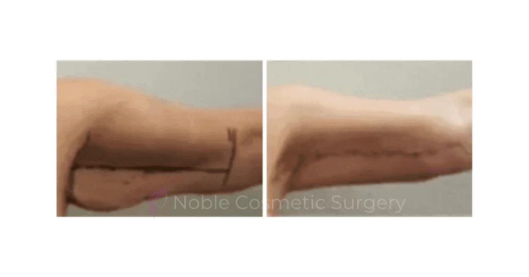 ARM-LIFT-CASE-00255 | Before and After Brachioplasty 1