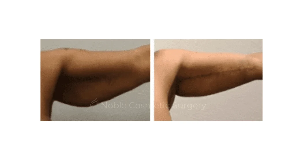 ARM-LIFT-CASE-00252 | Before and After Brachioplasty 1