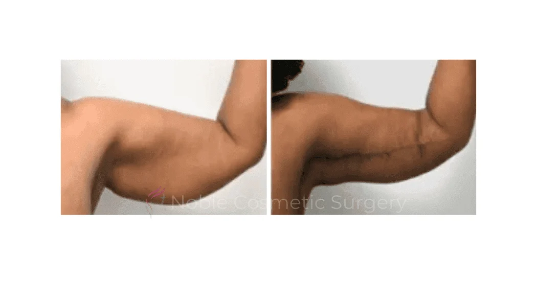 ARM-LIFT-CASE-00254 | Before and After Brachioplasty 1