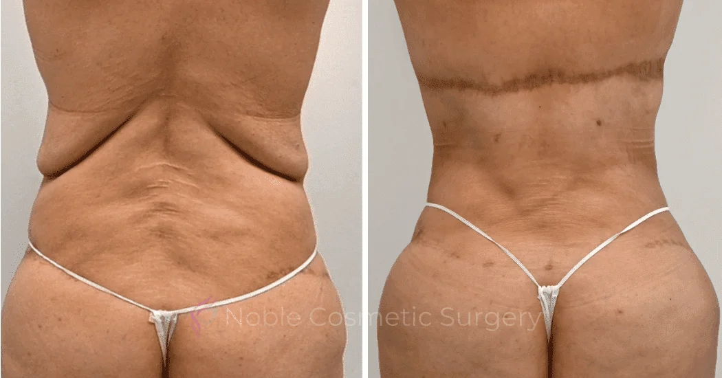 BACK-LIFT-CASE-00251 | Before and After Back Lift 1