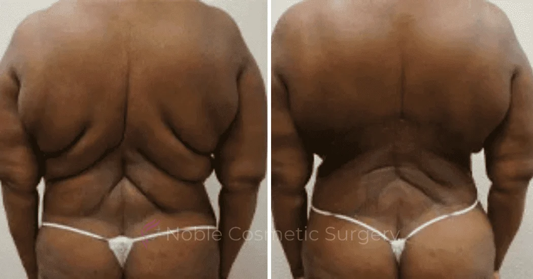 BACK-LIFT-CASE-00252 | Before and After Back Lift 1