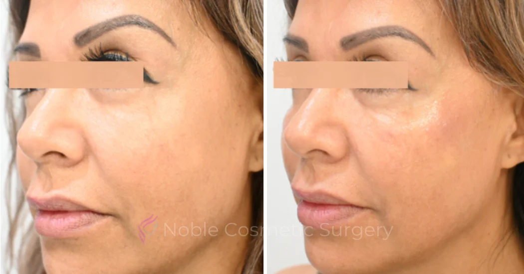 RF-MICRONEEDLING--CASE-00080 | Before and After RF Microneedling 1