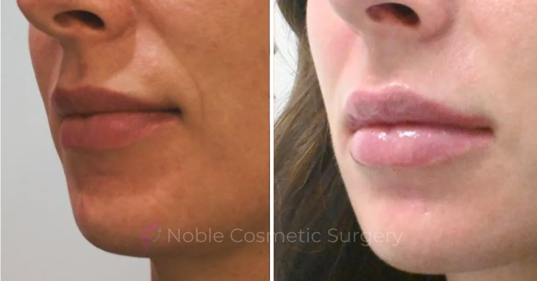 DERMAL-FILLERS-CASE-00260 | Before and After Dermal Fillers 1