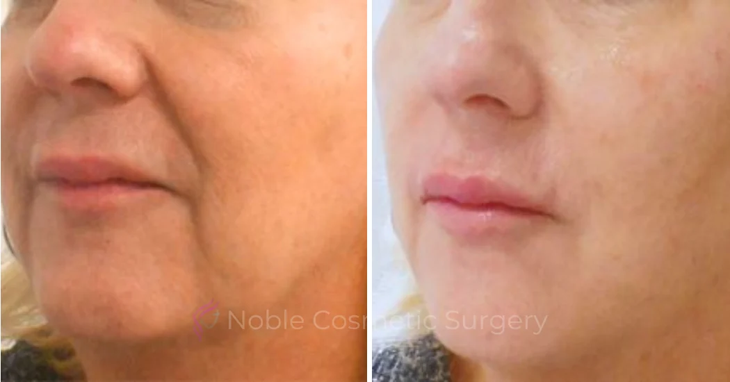 DERMAL-FILLERS-CASE-00262 | Before and After Dermal Fillers 1