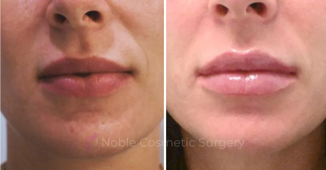 DERMAL-FILLERS-CASE-00263 | Before and After Dermal Fillers 1