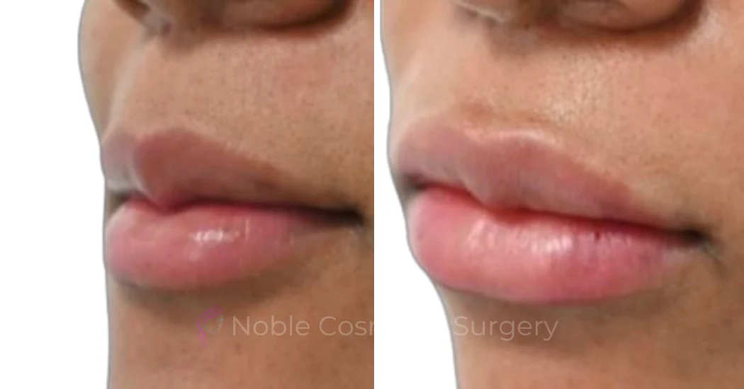 DERMAL-FILLERS-CASE-00264 | Before and After Dermal Fillers 1