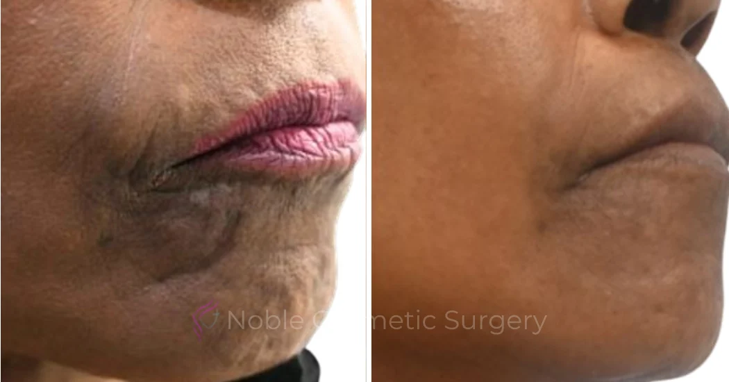 RF-MICRONEEDLING-CASE-00070 | Before and After RF Microneedling 1