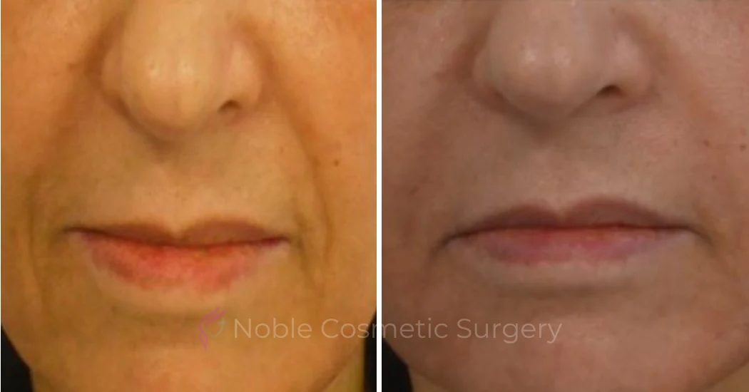 DERMAL-FILLERS-CASE-00266 | Before and After Dermal Fillers 1