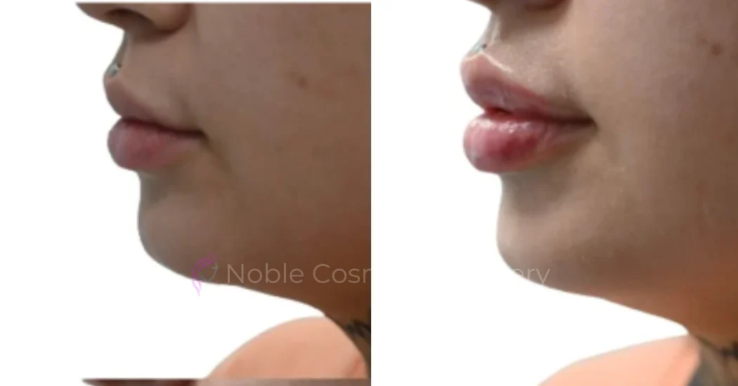 DERMAL-FILLERS-CASE-00267 | Before and After Dermal Fillers 1