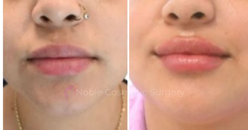 DERMAL-FILLERS-CASE-00268 | Before and After Dermal Fillers 1