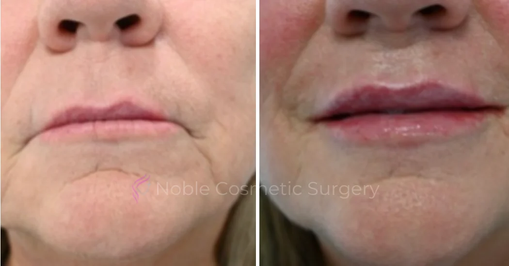 DERMAL-FILLERS-CASE-00269 | Before and After Dermal Fillers 1