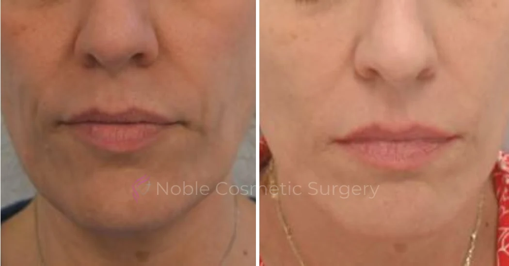 RF-MICRONEEDLING--CASE-00060 | Before and After RF Microneedling 1
