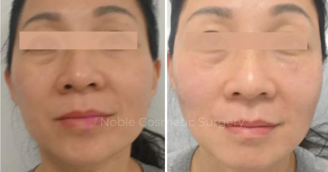 RF-MICRONEEDLING-CASE-00040 | Before and After RF Microneedling 1