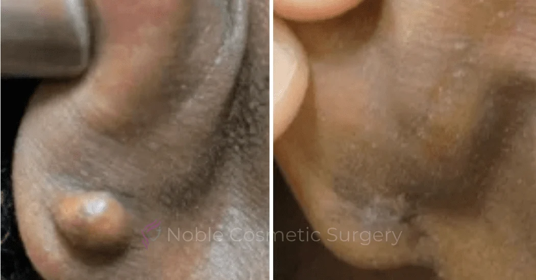 Earlobe-Repair-Case-20251 | Before and After Earlobe Repair 1