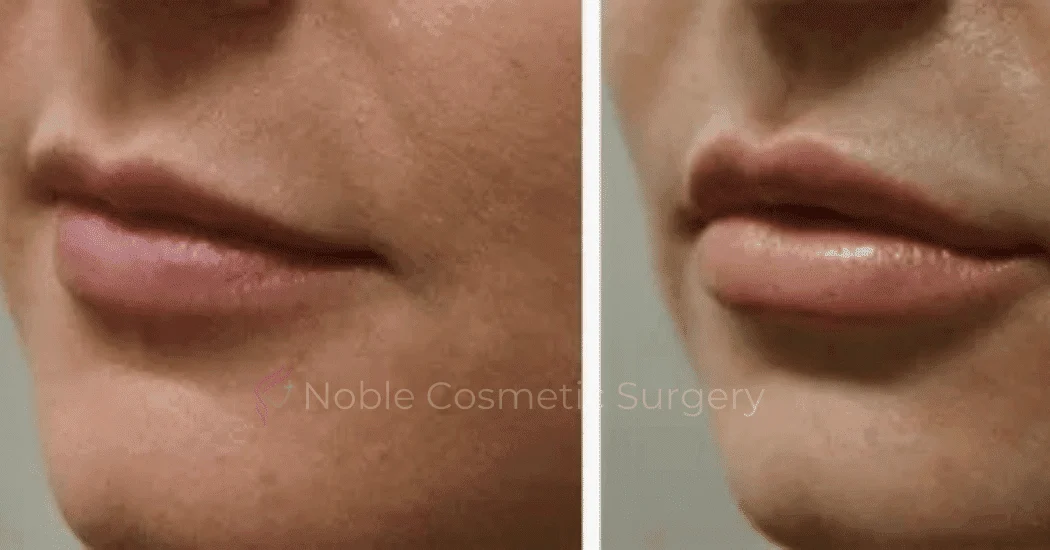 DERMAL-FILLERS-CASE-00257 | Before and After Dermal Fillers 1