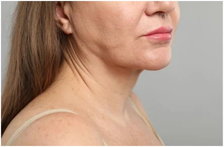 Rediscover a Youthful You: Lower Face and Neck Lift Surgery by Dr. Patrick C. Obasi in Plano, TX