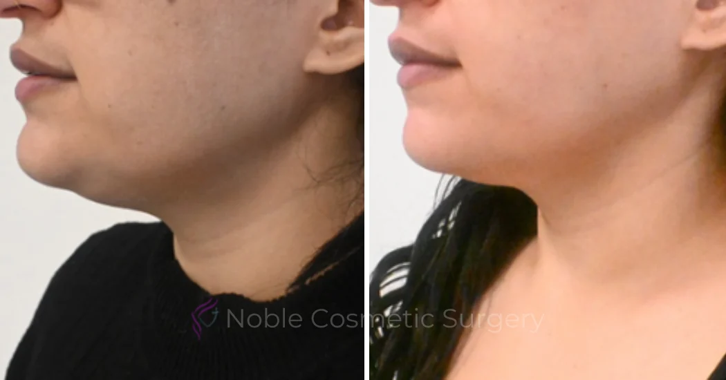 KYBELLA-CASE-00100 | Before and After Kybella 1
