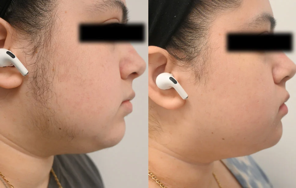 Laser-Hair-Removal-Case--8237 | Before and After Laser Hair Removal 1