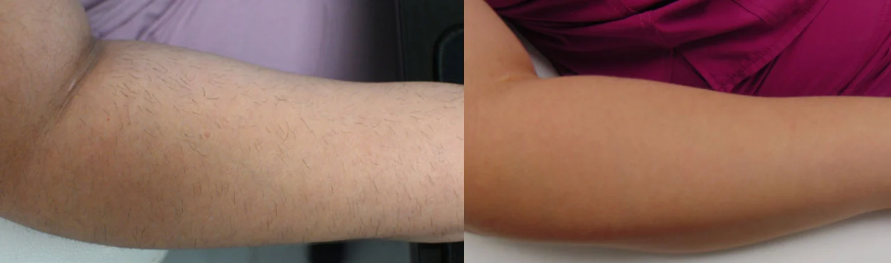 Laser-Hair-Removal--Case--1292 | Before and After Laser Hair Removal 1