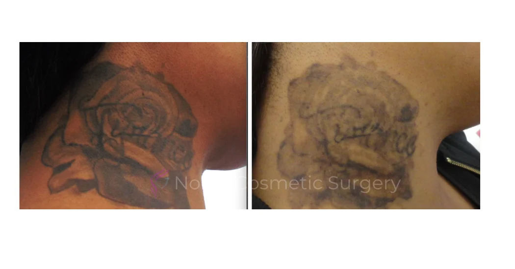 LASER-TATTOO-REMOVAL-CASE-00002 | Before and After Laser Tattoo Removal 1
